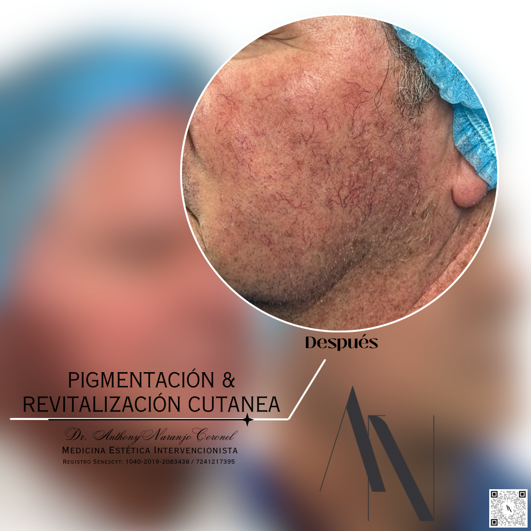 acido no ret