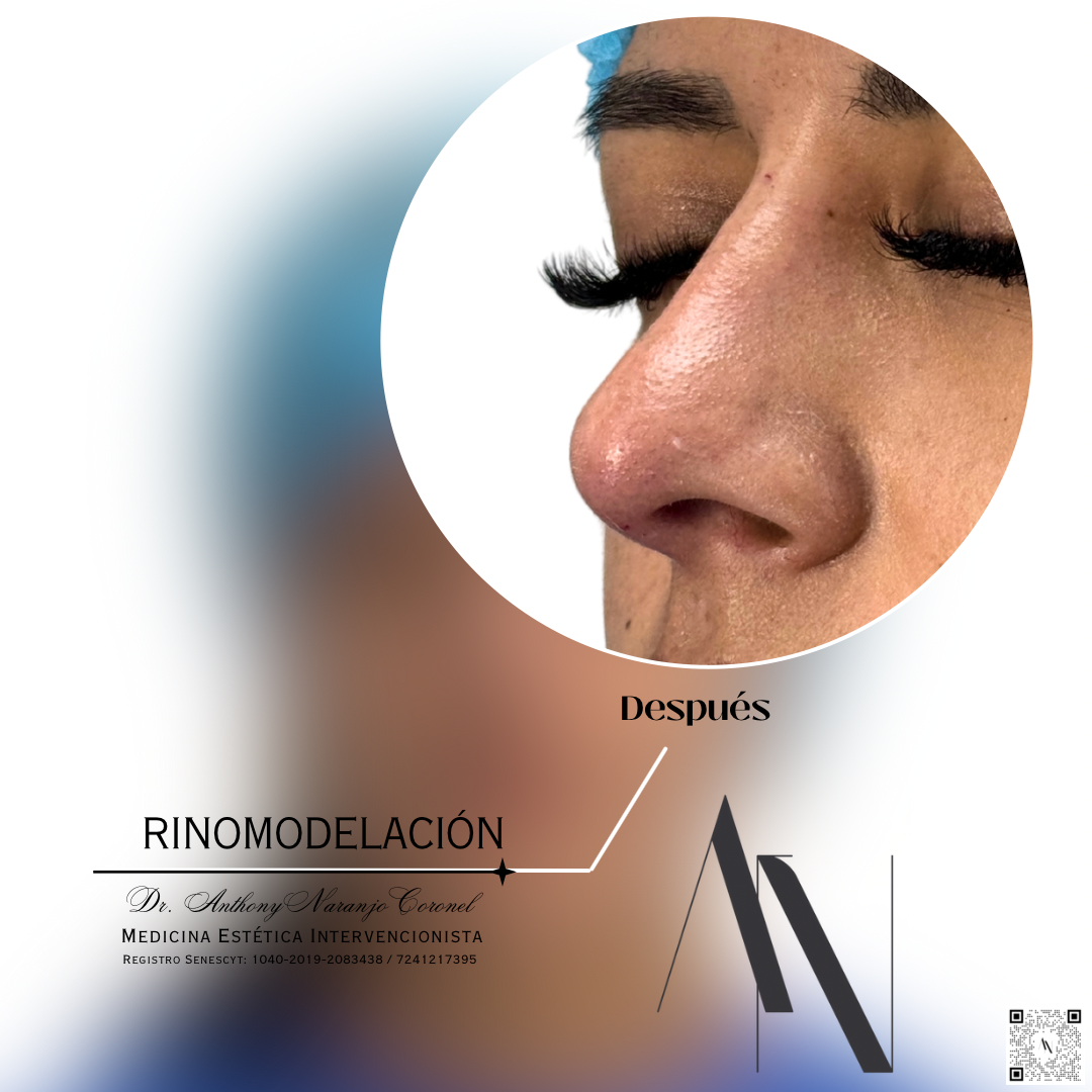 acido reticulado - rino