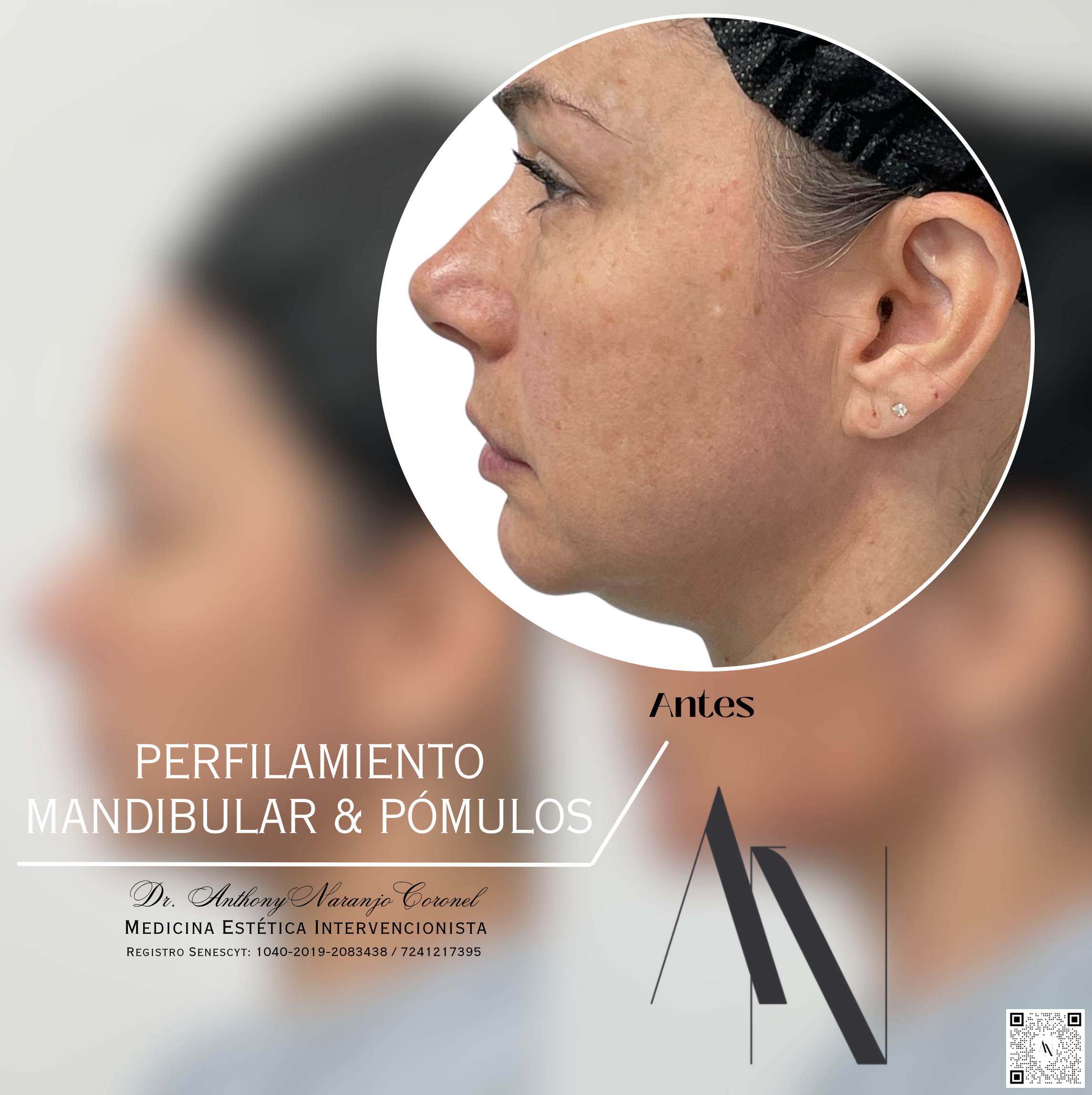 acido reticulado - mandibula