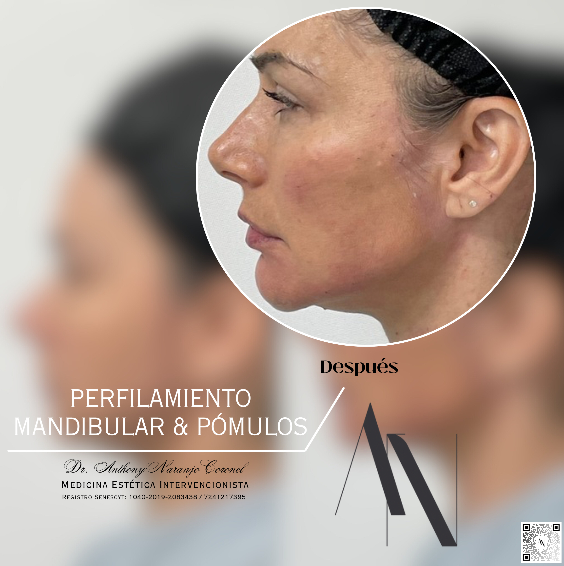 acido reticulado - mandibula