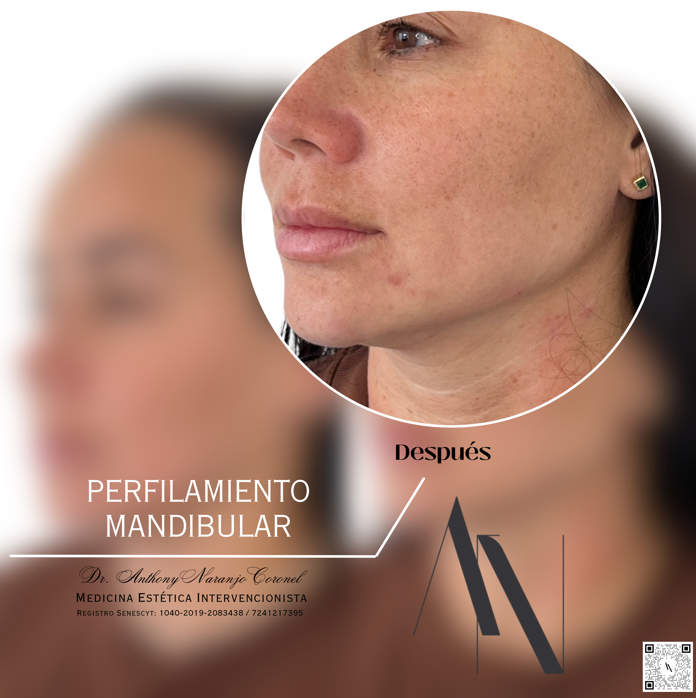 acido reticulado - mandibula