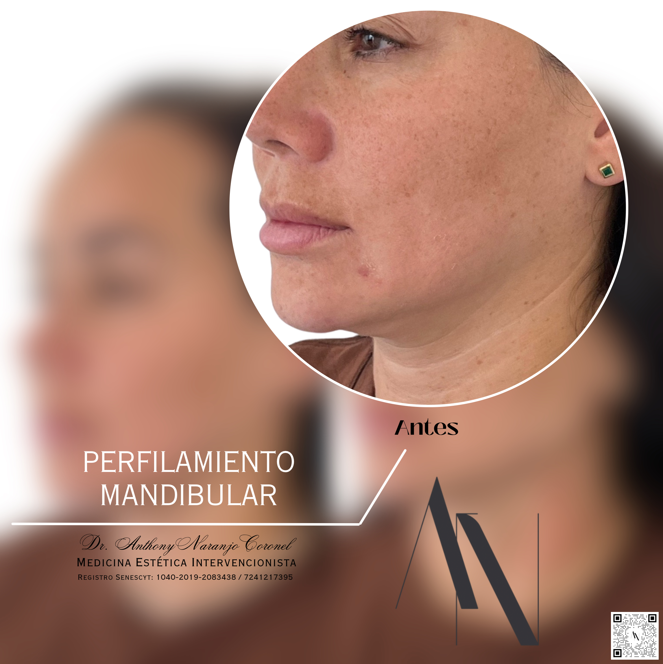 acido reticulado - mandibula