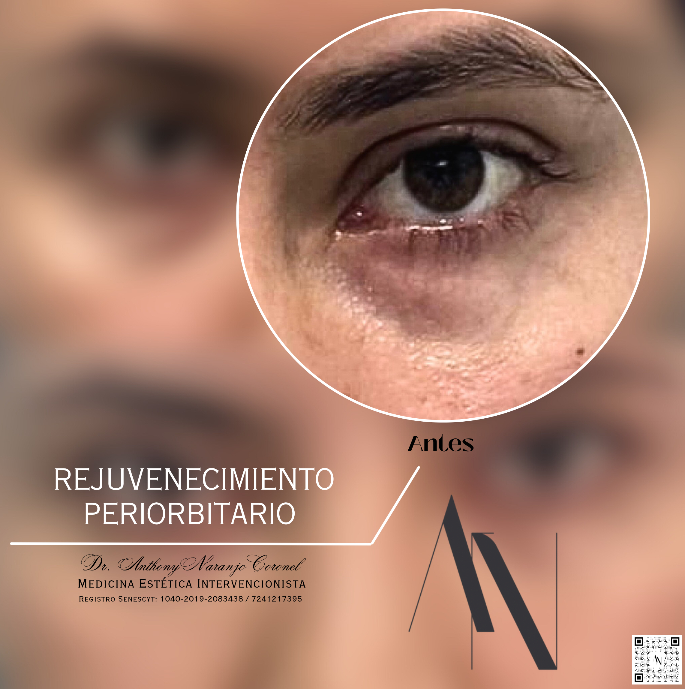 acido reticulado - ojeras