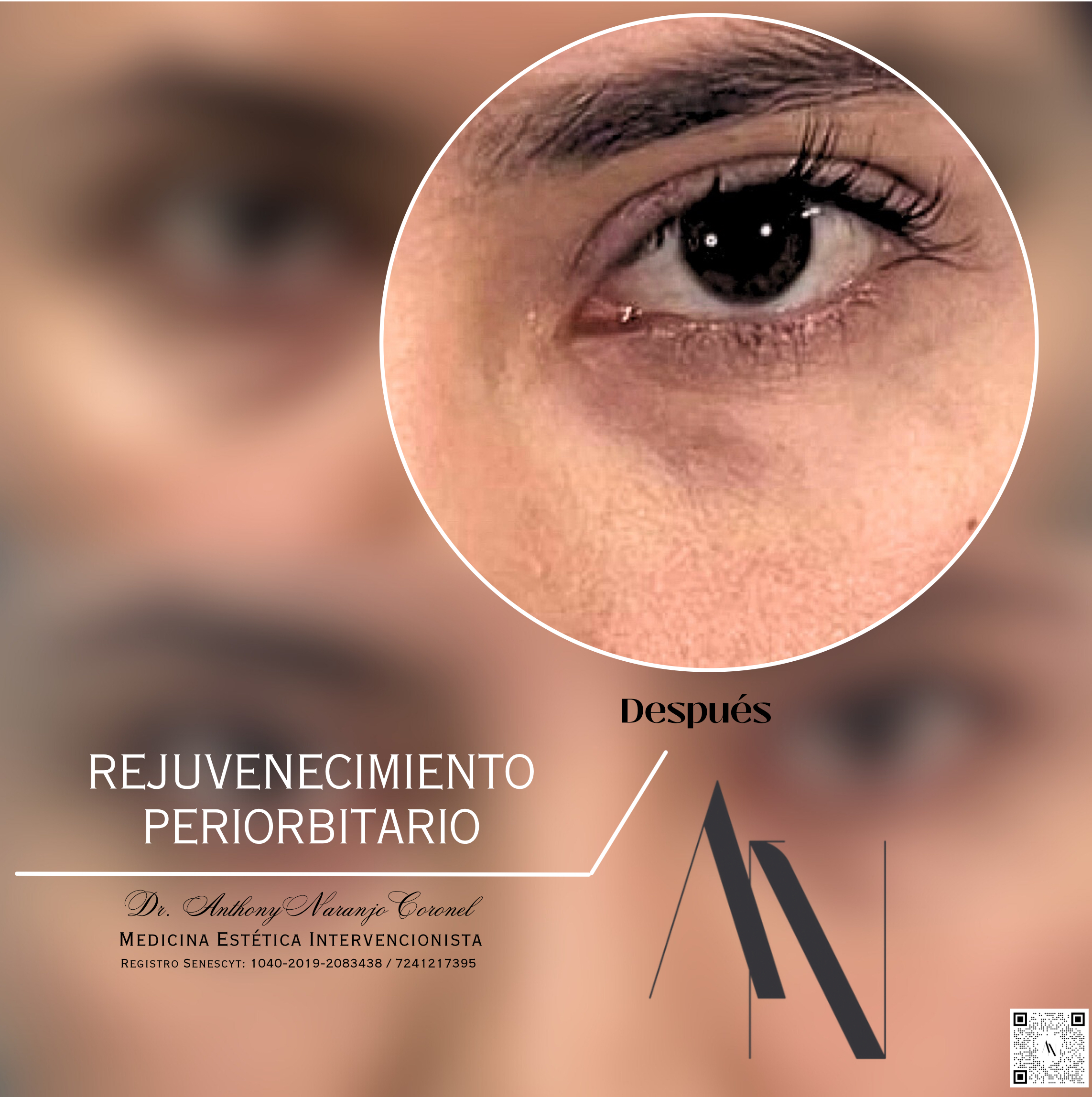 acido reticulado - ojeras