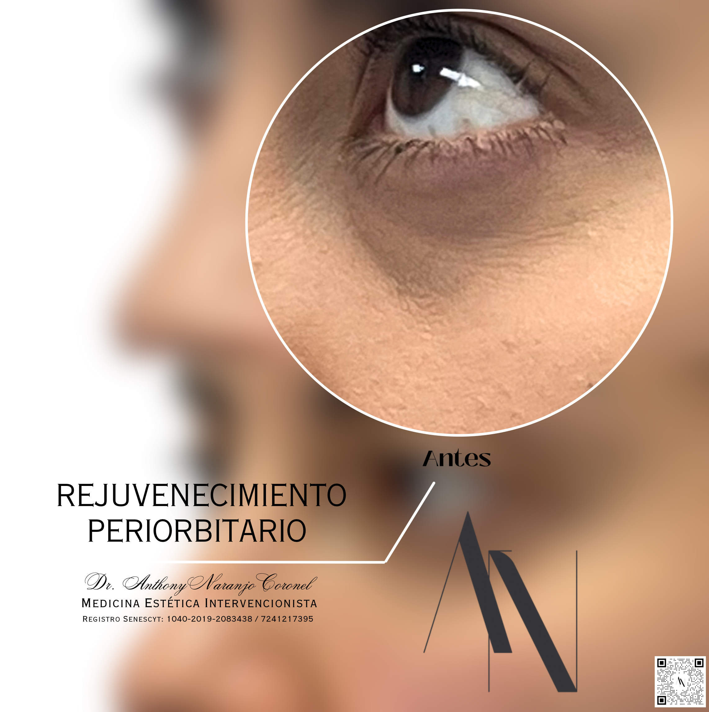 acido reticulado - ojeras