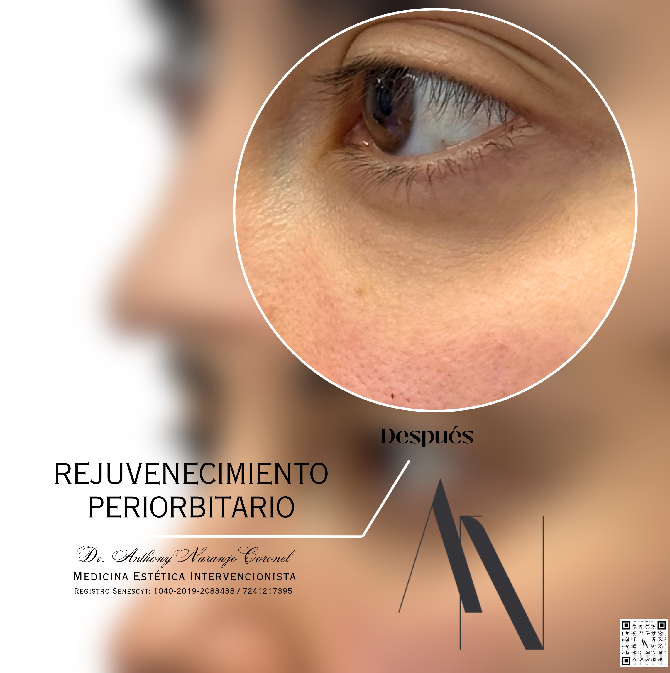 acido reticulado - ojeras