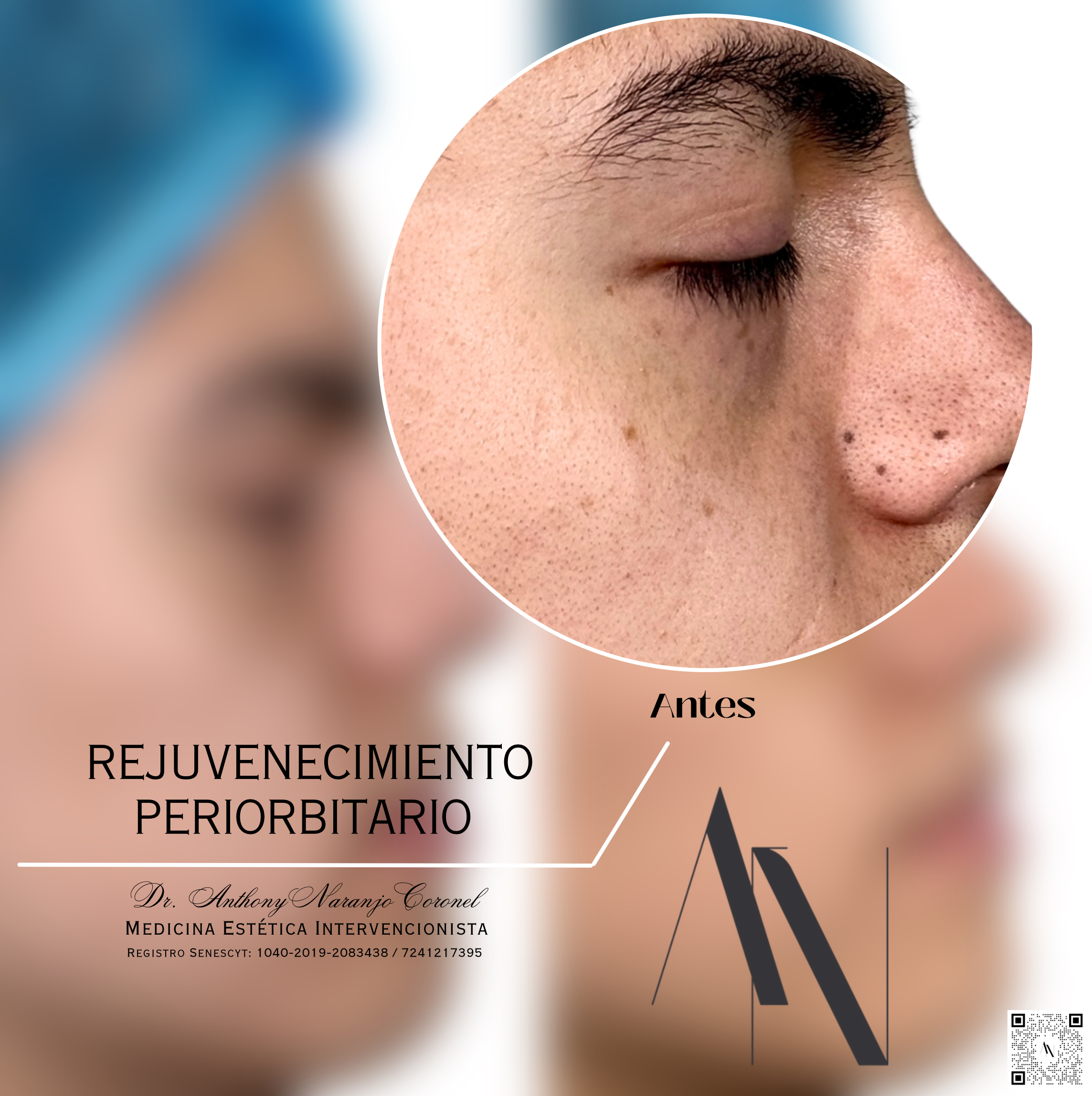 acido reticulado - ojeras