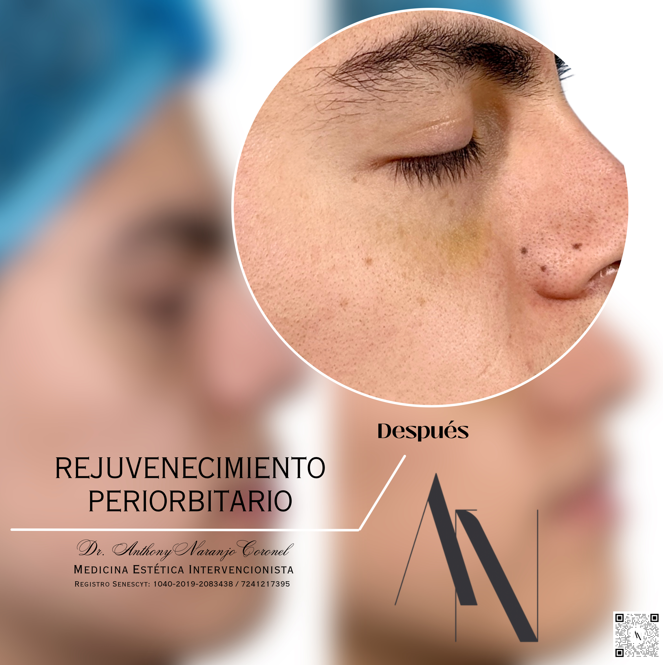 acido reticulado - ojeras