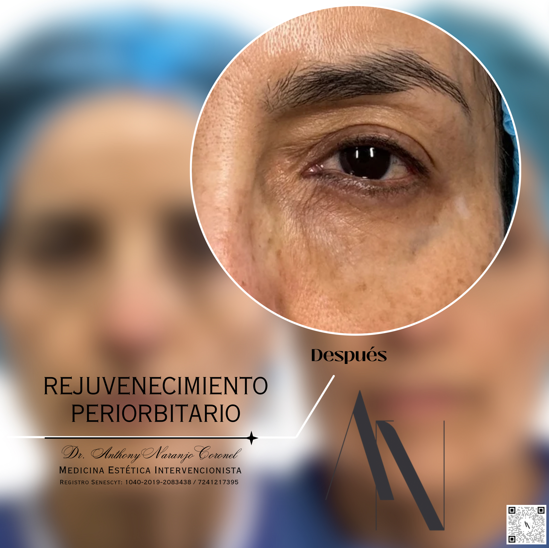 acido reticulado - ojeras