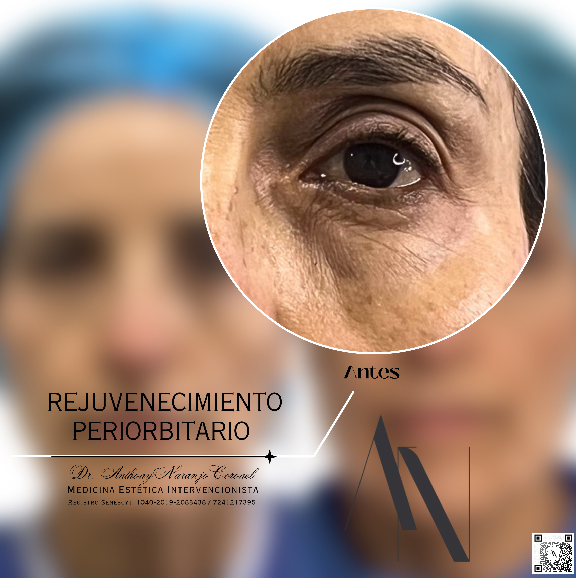 acido reticulado - ojeras