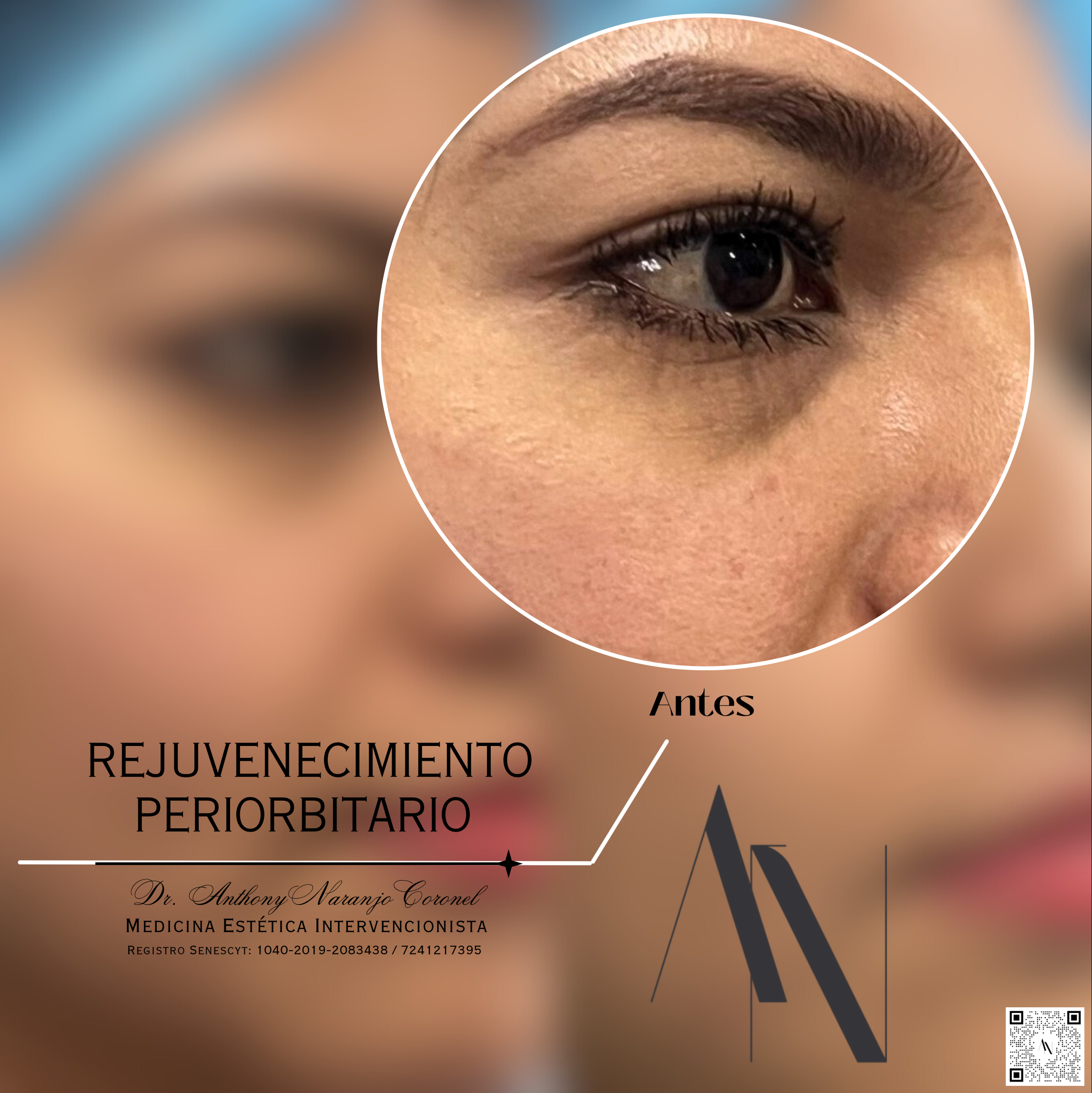 acido reticulado - ojeras
