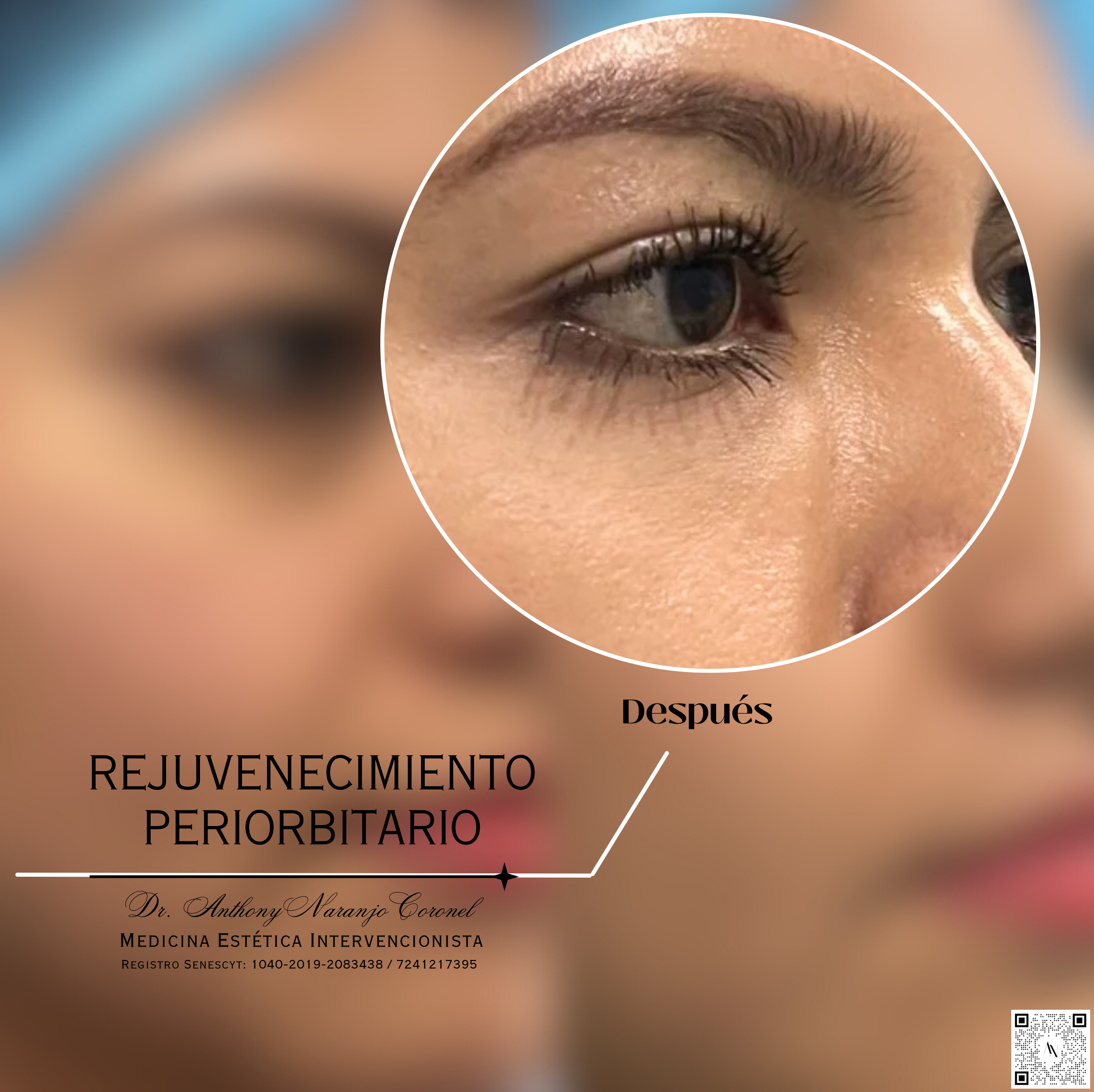 acido reticulado - ojeras