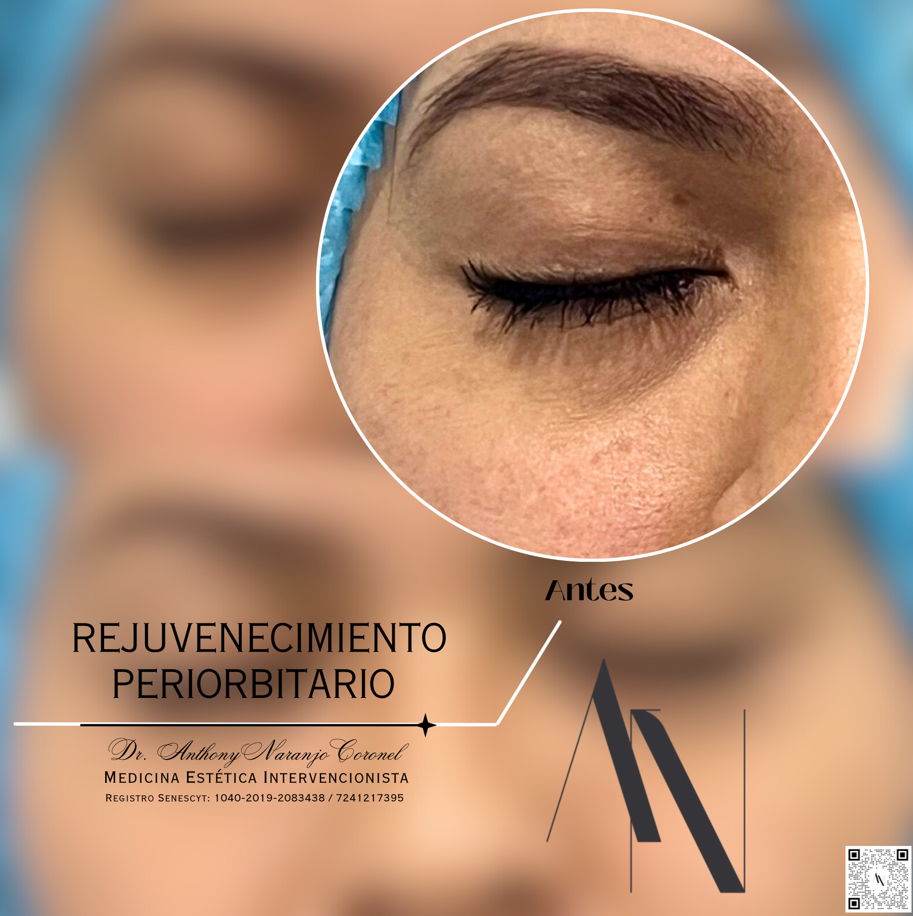 acido reticulado - ojeras