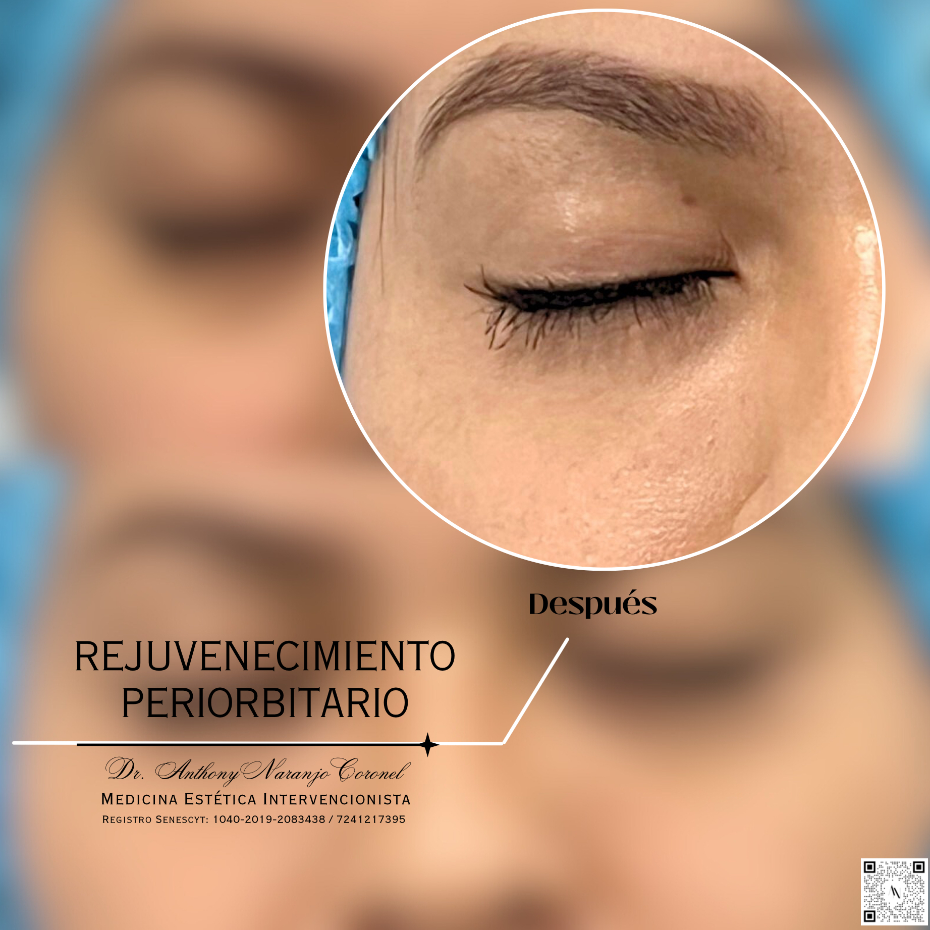 acido reticulado - ojeras