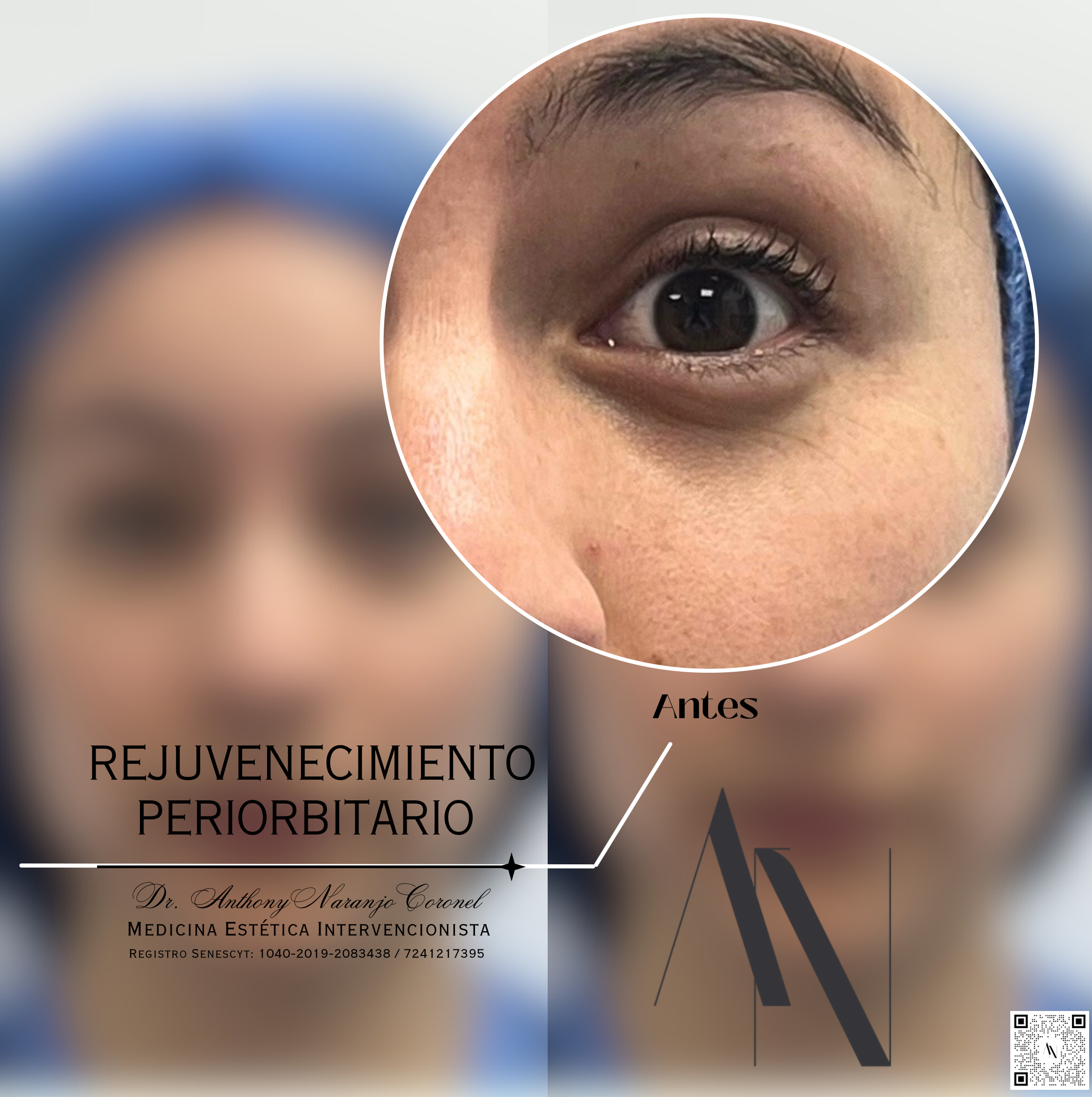 acido reticulado - ojeras