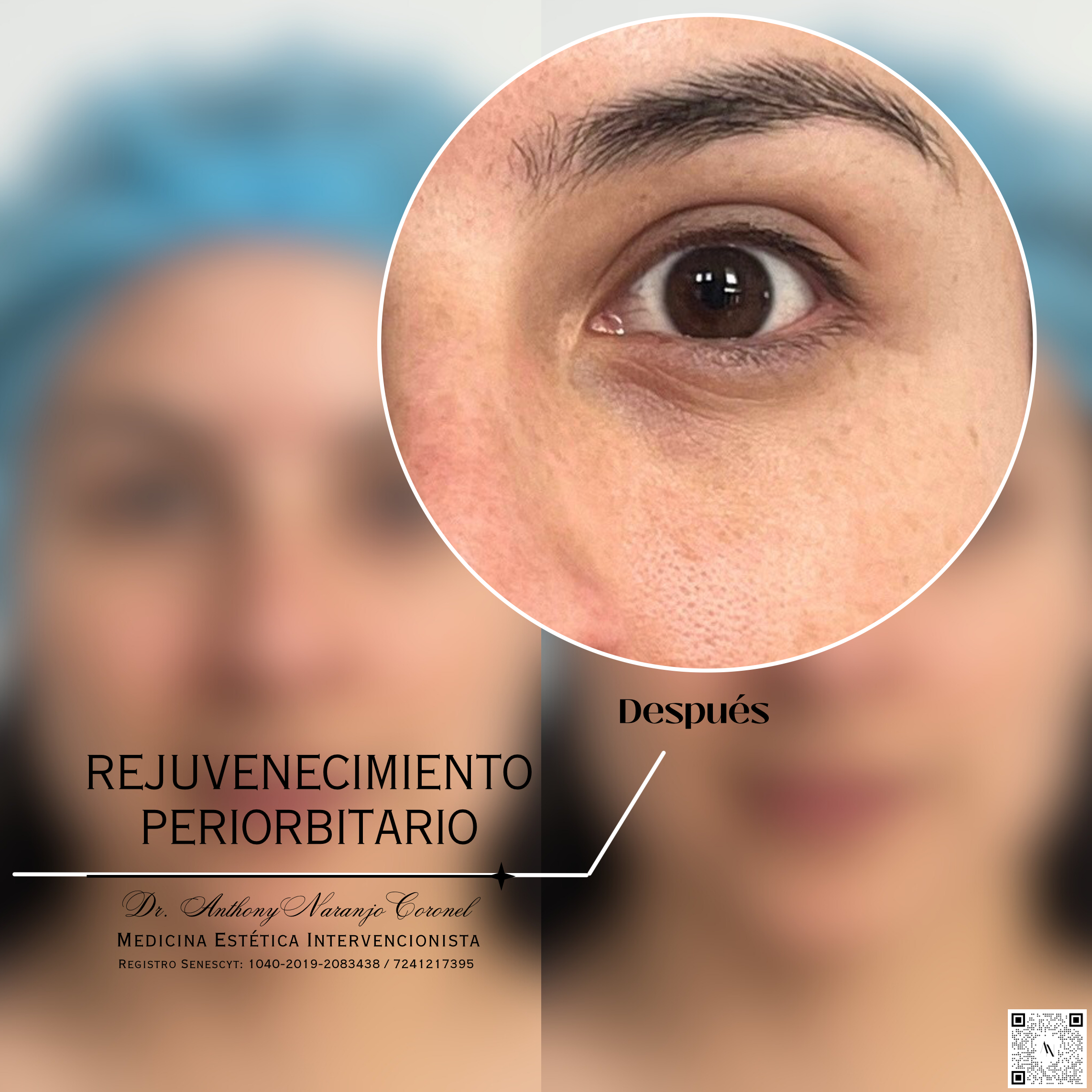 acido reticulado - ojeras