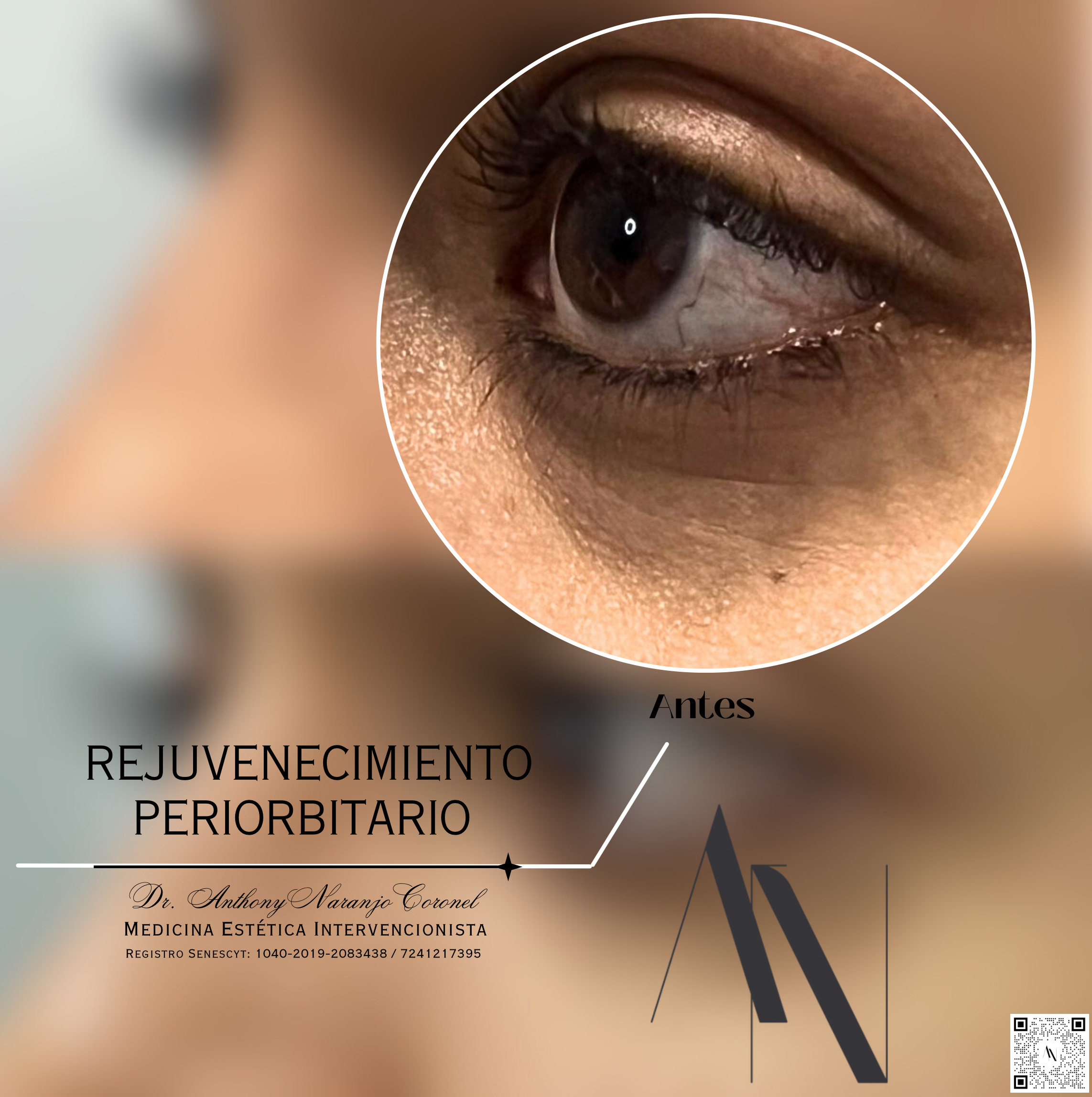 acido reticulado - ojeras