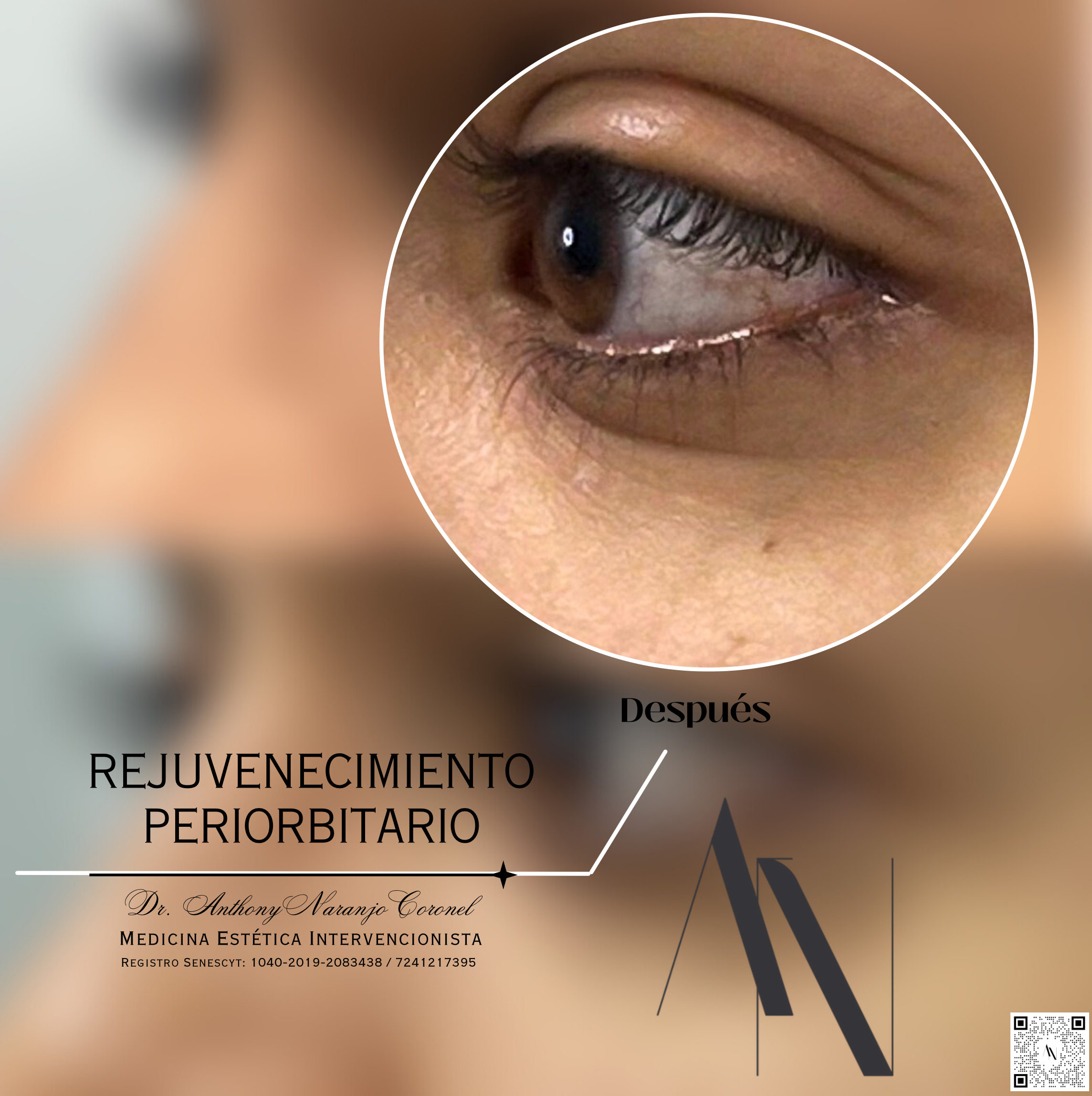 acido reticulado - ojeras