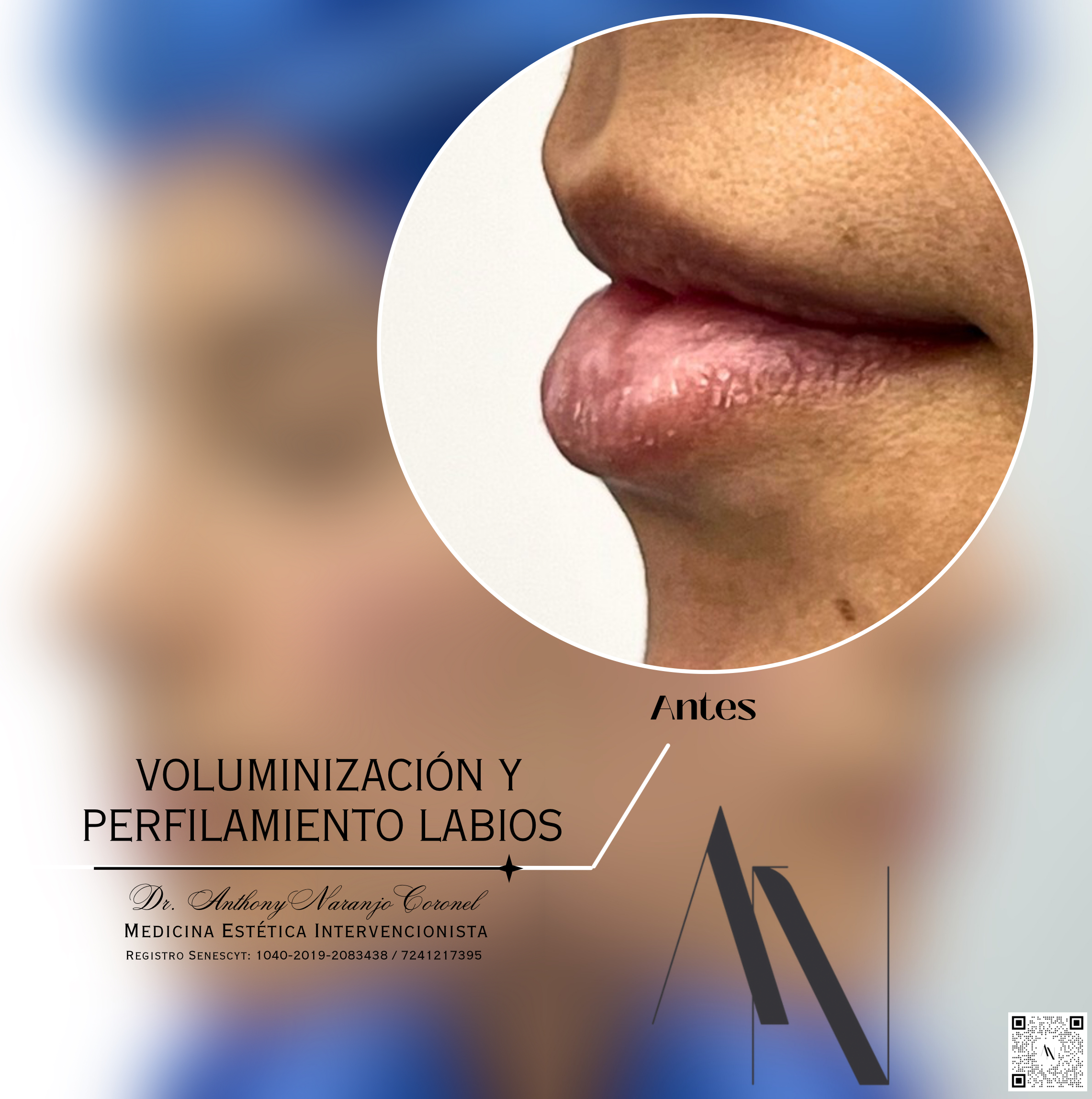 acido reticulado - labios