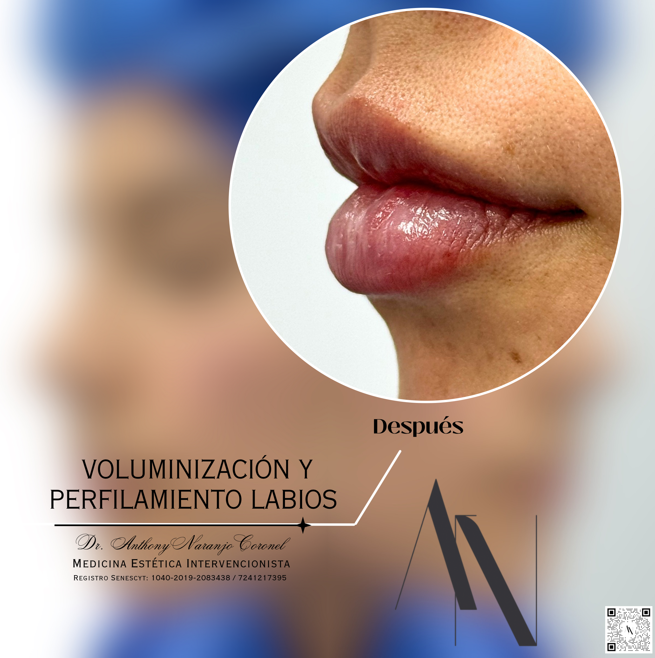 acido reticulado - labios