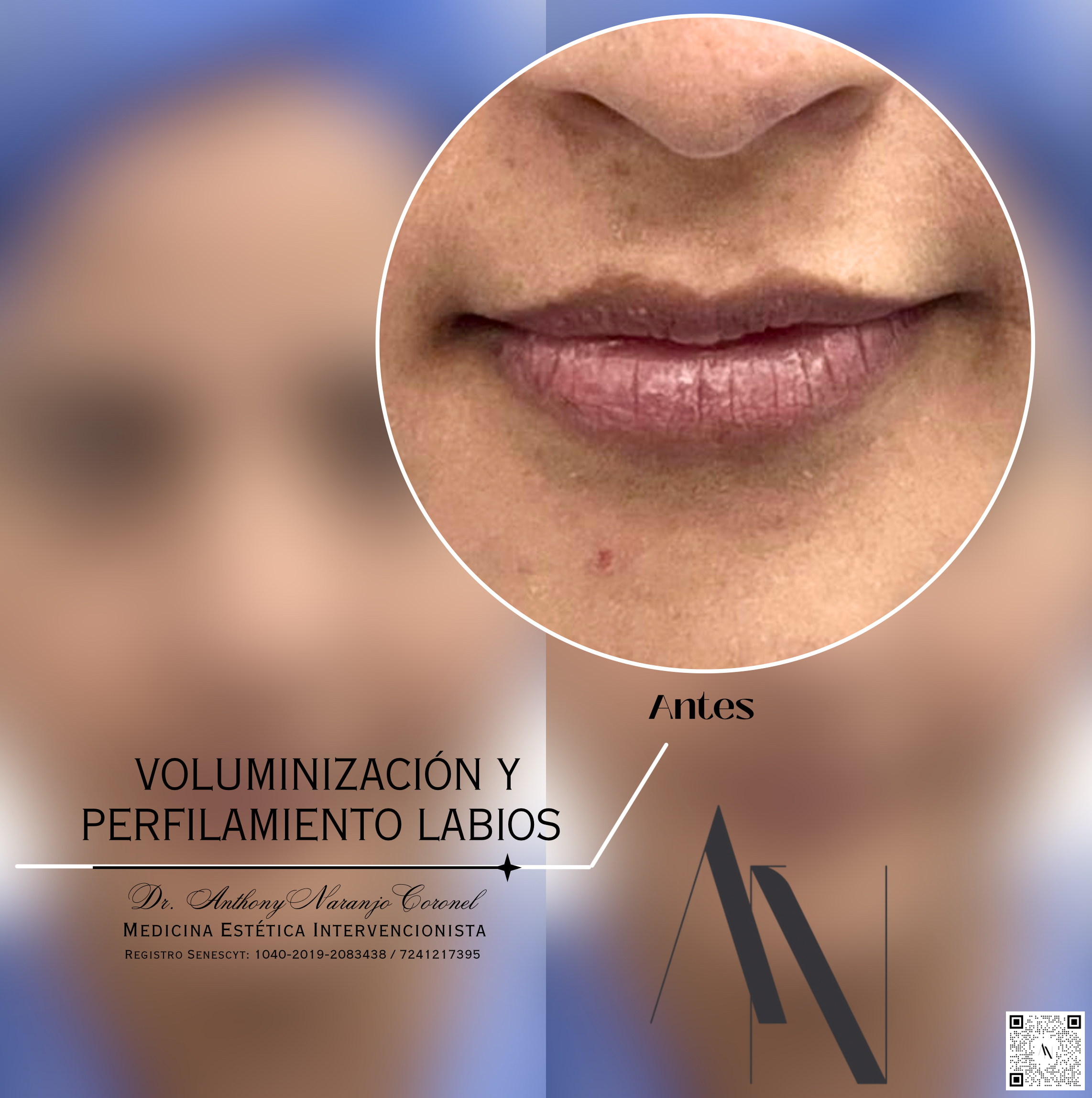 acido reticulado - labios