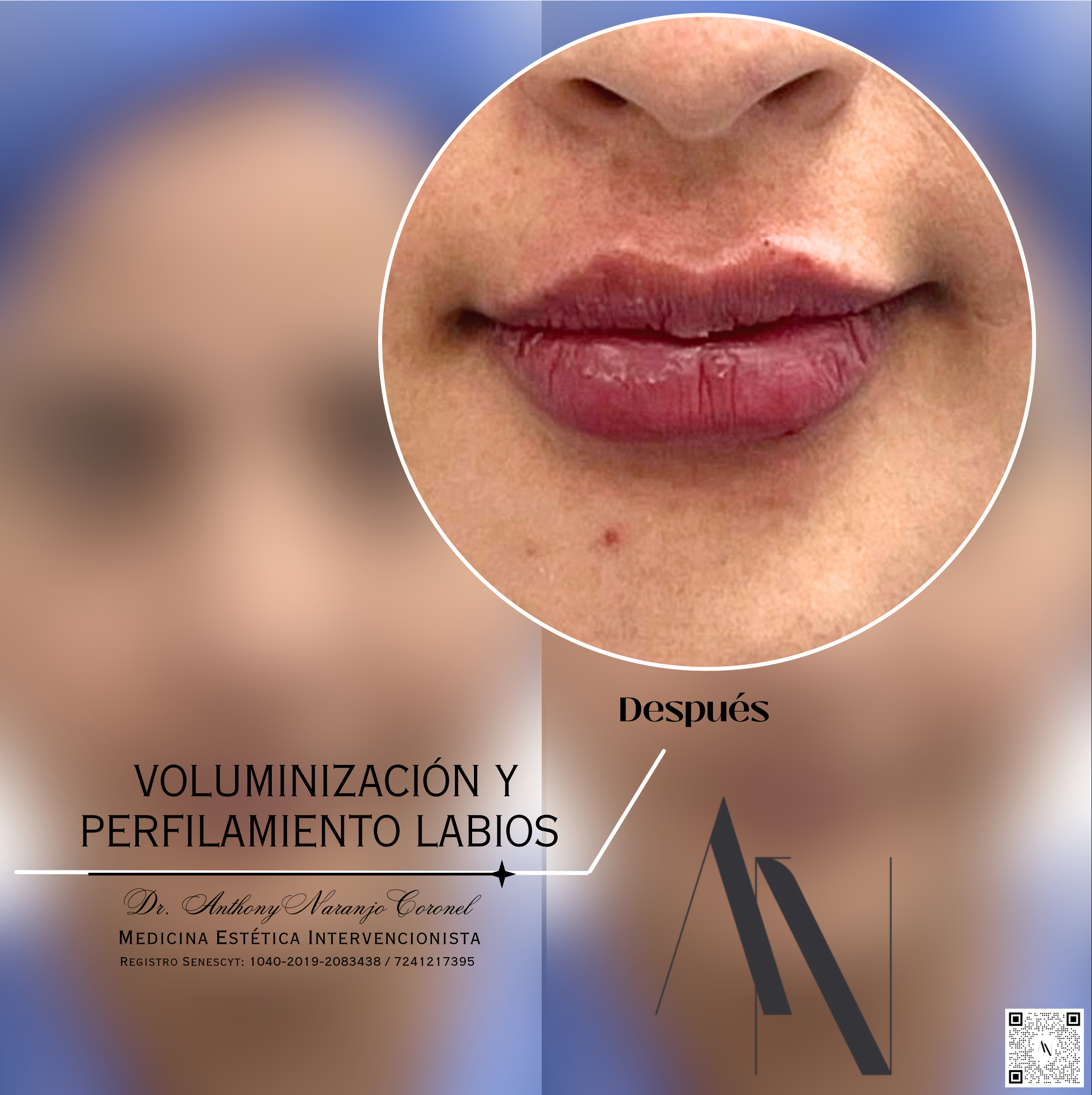 acido reticulado - labios
