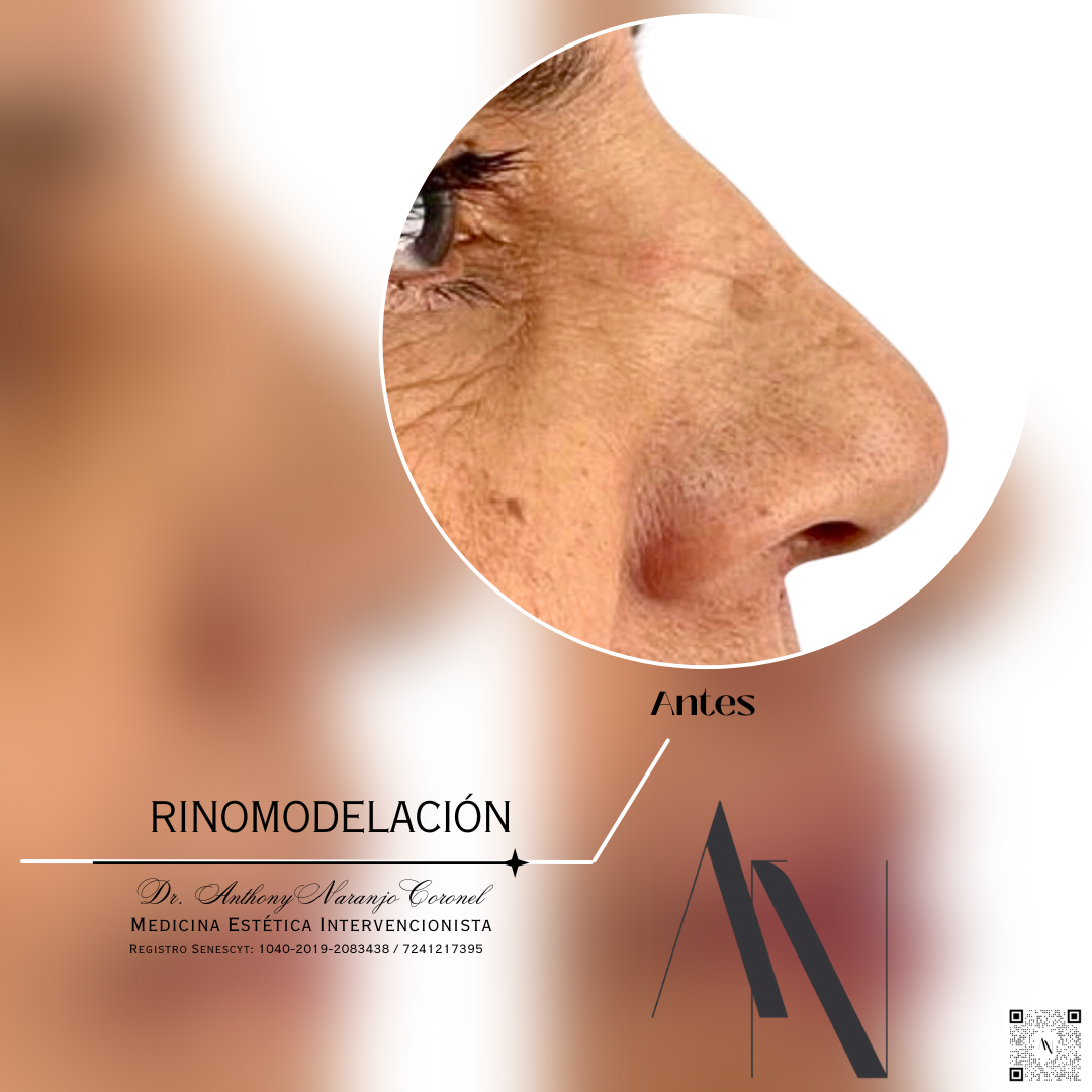 acido reticulado - rino