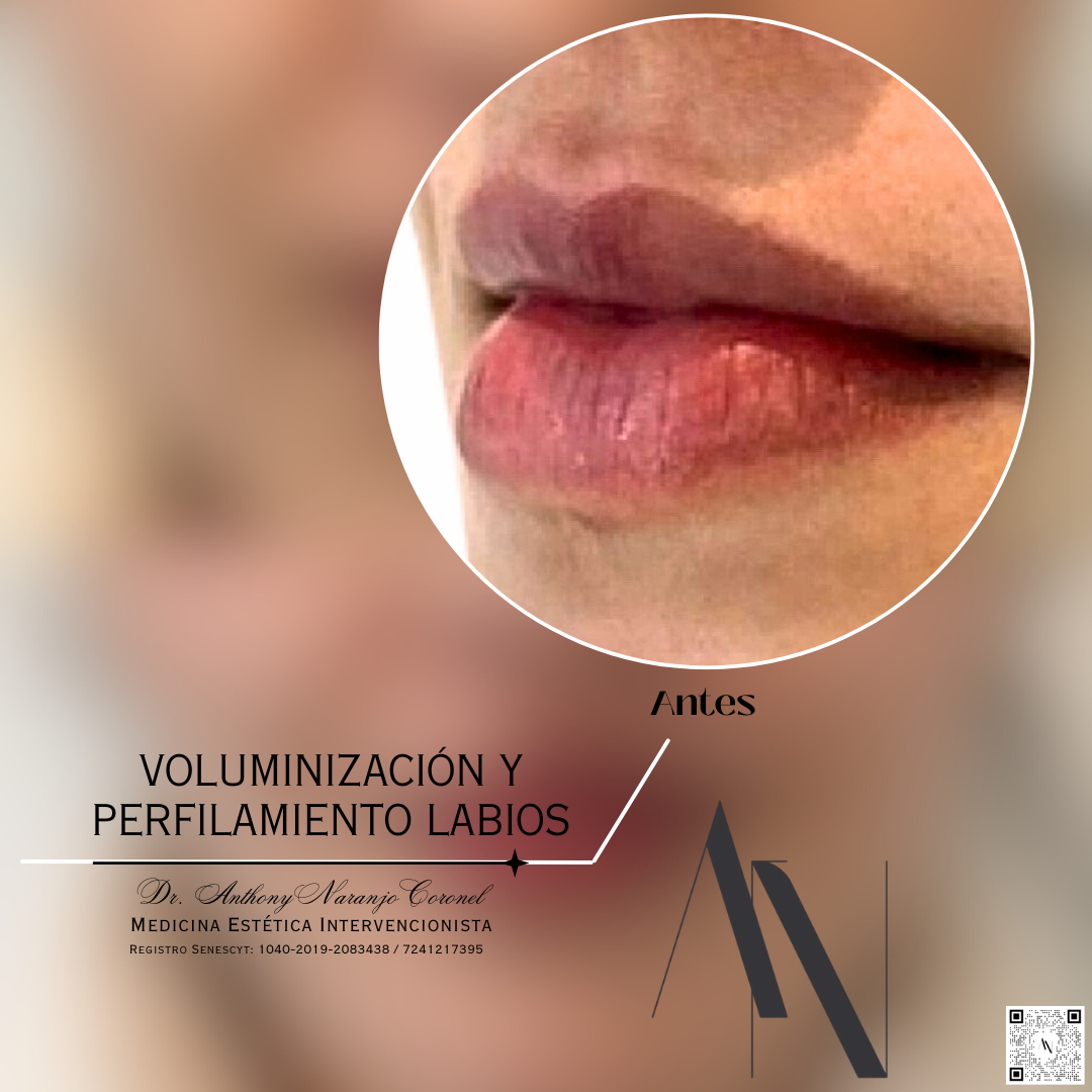 acido reticulado - labios