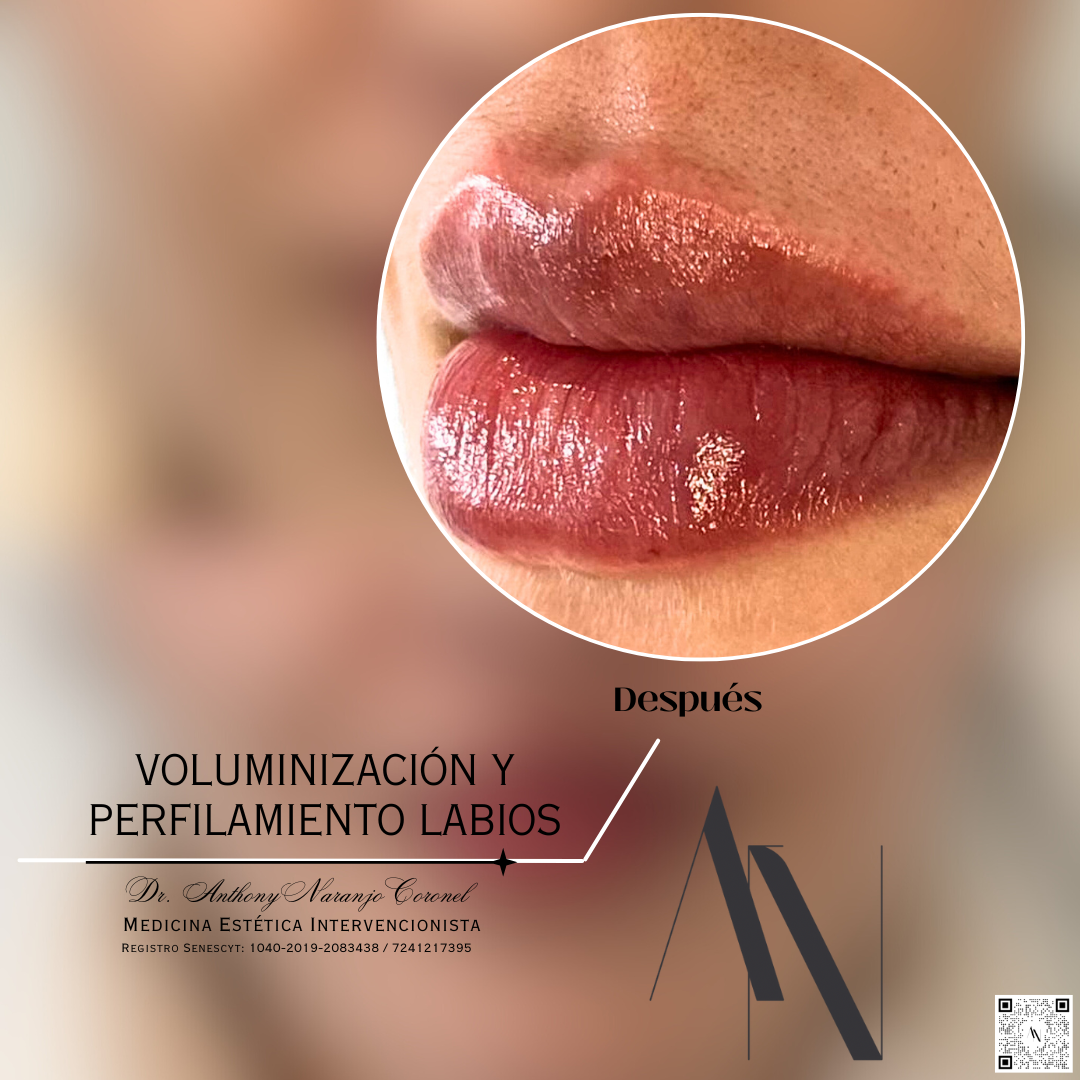 acido reticulado - labios